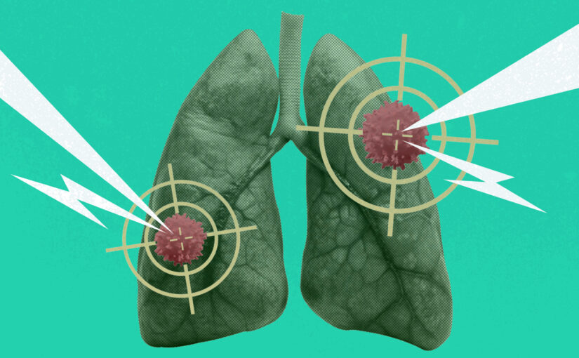 La radiothérapie flash, futur traitement du cancer ?