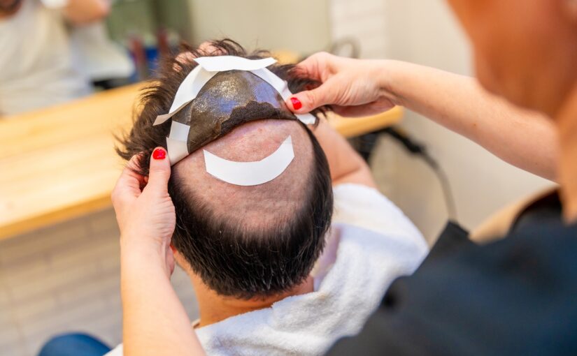 Une meilleure prise en charge des prothèses capillaires