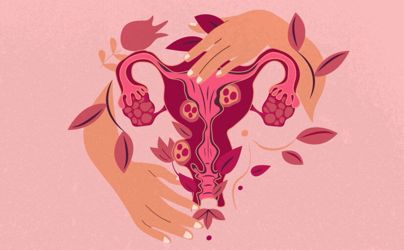 Le fibrome utérin, la maladie gynécologique la plus fréquente